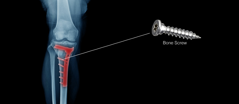 醫(yī)療骨釘加工<a href='/gaosuzhuzhou.htm' class='keys' title='點擊查看關于高速主軸的相關信息' target='_blank'>高速主軸</a>.png